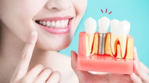 Everything You Need to Know About All on 4 Dental Implants Everything You Need to Know About All on 4 Dental Implants